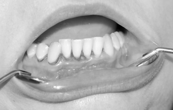 Dentalni centar DentIN, Zagreb, Trešnjevka: prednji donji zubi prekriveni nakupinom zubnog kamenca, naslovna fotografija, crno-bijelo