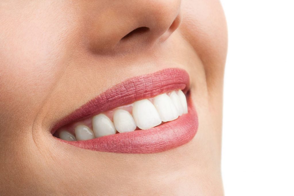 Dentalna klinika DentIN: lijep osmijeh na mladoj ženskoj osobi zahvaljujući zubnim ljuskicama