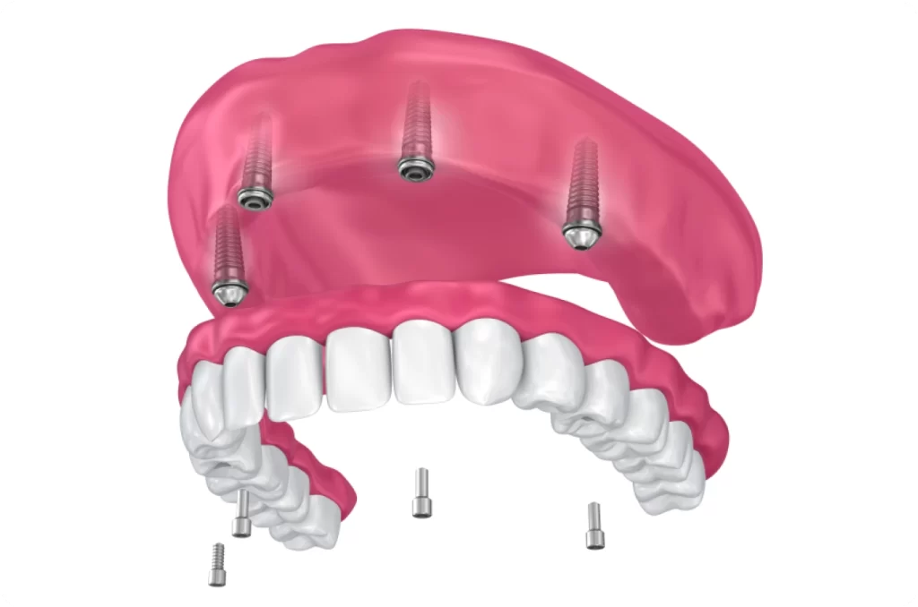 Dentalni centar DentIN, Zagreb, Trešnjevka: ilustracija implantološkog rješenja za nadomjestak svih zubi čeljusti, All-on-4