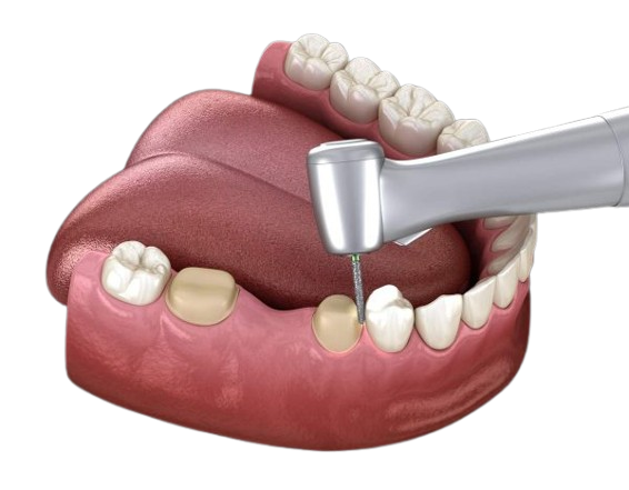Dentalna klinika DentIN, Zagreb: ilustracija oblikovanja zubi brušenjem kako bi se na njih oslonio zubni most.
