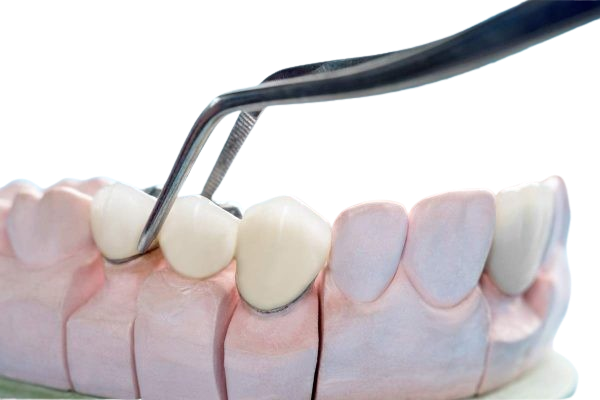 Dentalna klinika DentIN, Zagreb: ilustracija postavljanja zubnog mosta na zube, što se vrši cementiranjem.