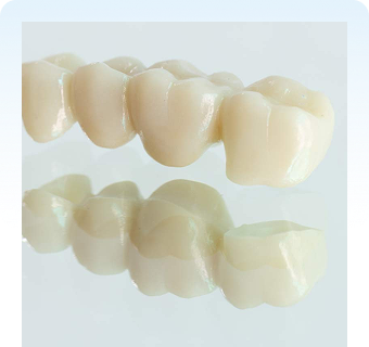 Dentalna klinika DentIN, Zagreb: zubni most od 4 bezmetalne zubne krunice.