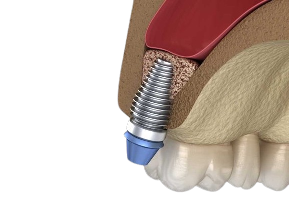 Dentalna klinika DentIN, Zagreb: ilustracija zubnog implantata ugrađenog u gornju čeljust.