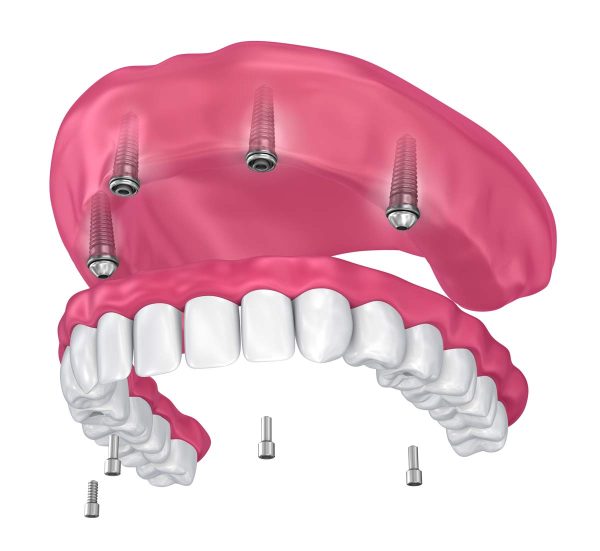 Dentalni centar DentIN, Zagreb: grafički prikaz implantološkog protetskog rješenja All-on-4.