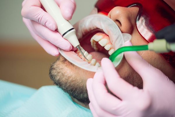 Dentalni centar DentIN, Zagreb, Trešnjevka: čišćenje zubnog kamenca ultrazvučnim čistačem.