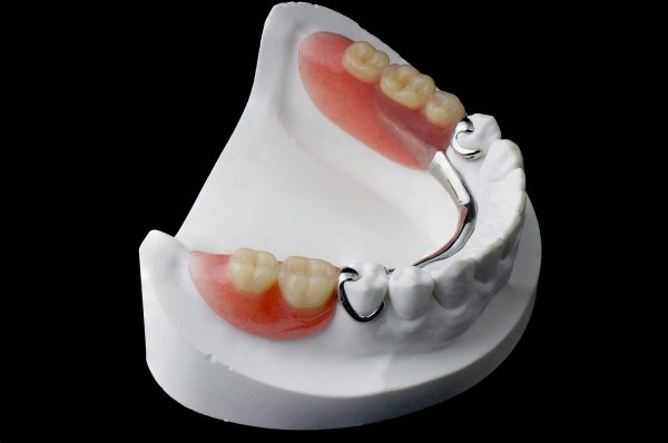 Dentalni centar DentIN, Zagreb: djelomična ili parcijalna zubna proteza.