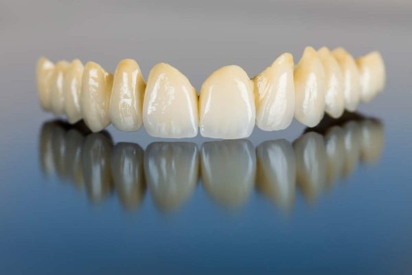 Dentalni centar DentIN, Zagreb: gornji keramički most All-on-4, implantološko protetsko rješenje.