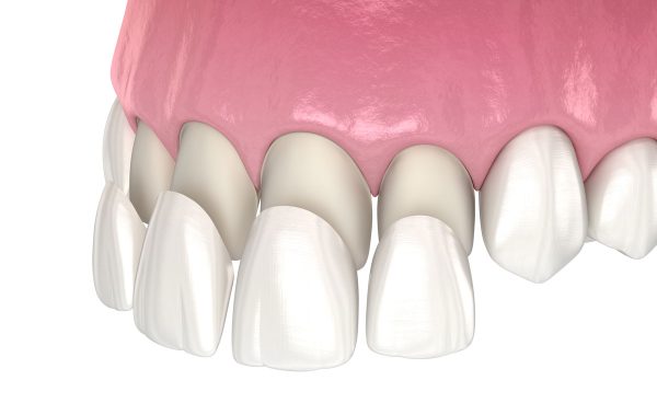 Dentalni centar DentIN, Zagreb: grafički prikaz postavljanja keramičkih ljuskica za zube.