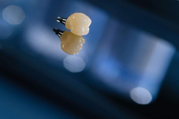 Dentalni centar DentIN, Zagreb: bezmetalna krunica spremna za postavljanje na zubni implantat.