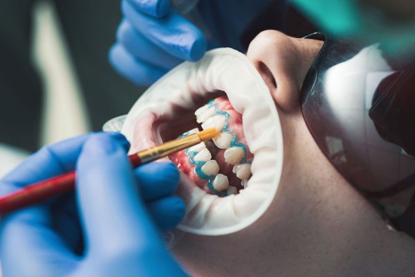 Dentalni centar DentIN, Zagreb: nanošenje gela za izbjeljivanje zubi.