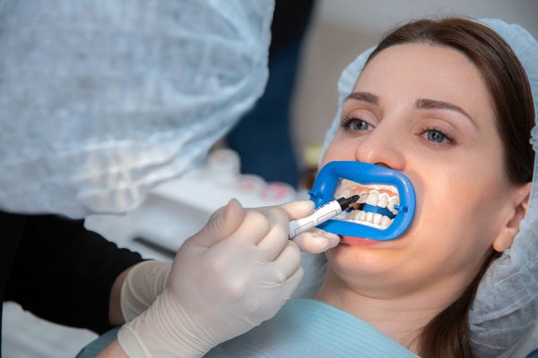 Dentalni centar DentIN, Zagreb: zaštita zubnog mesa prije izbjeljivanja zubi.