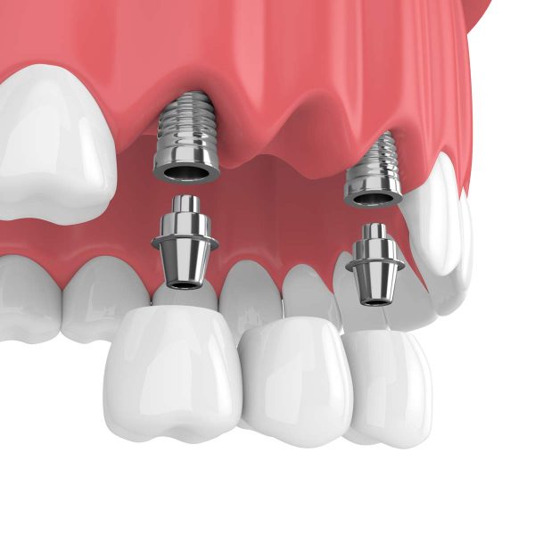 Dentalni centar DentIN, Zagreb: zubni most na zubnim implantatima, grafika.