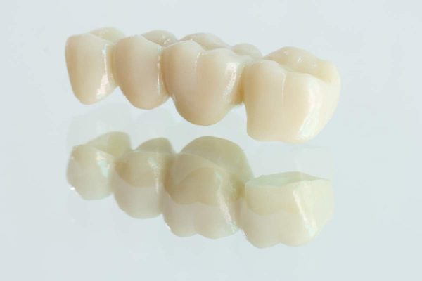 Dentalni centar DentIN, Zagreb: zubni most izrađen od cirkona, grafika.