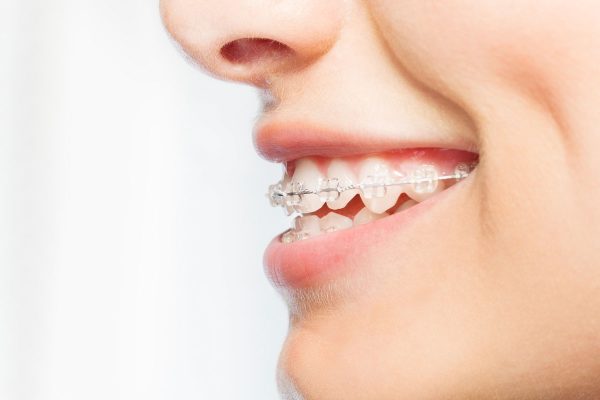 Dentalni centar DentIN, Zagreb, Trešnjevka: djevojka, profil, nosi fiksni estetski zubni aparatić.