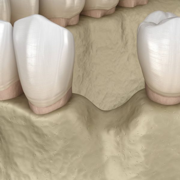 Dentalni centar DentIN, Zagreb: prikaz gubitka čeljusne kosti na mjestu izgubljenog zuba.