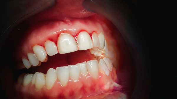 Dentalni centar DentIN, Zagreb, Trešnjevka: krvarenje desni, rani stadij parodontitisa.