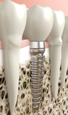 Dentalni centar DentIN, Zagreb: grafički prikaz oseointegracije, tj. procesa srastanja zubnog implantata s čeljusnom kosti.