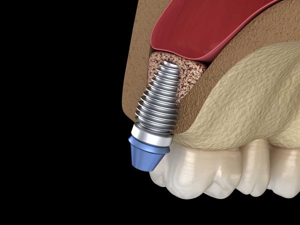 Dentalni centar DentIN, Zagreb: podizanje sinusa ugradnjom koštanog nadomjestka, Sinus Lift.