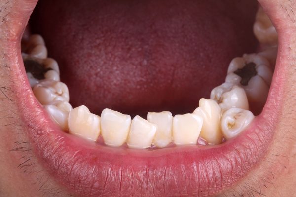 Dentalni centar DentIN, Zagreb, Trešnjevka: fotografija donje čeljusti sa ortodontskom anomalijom zbijenih zubi.
