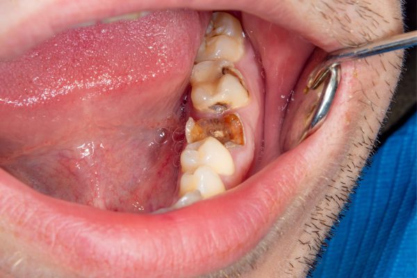 Dentalni centar DentIN, Zagreb, Trešnjevka: kutnjak koji je u cijelosti stradao od karijesa.
