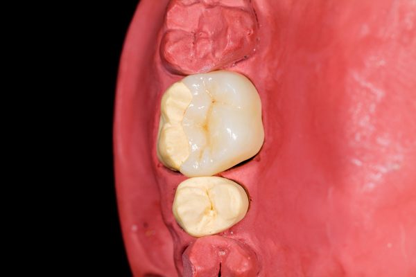 Dentalni centar DentIN, Zagreb, Trešnjevka: keramički umetak ili ispun po principu overlay, isprobavanje na modelu otiska.