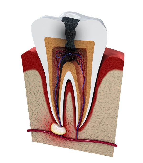Dentalni centar DentIN, Trešnjevka, Zagreb: grafički prikaz razvoja upala zubne pulpe, gangrene i granuloma.