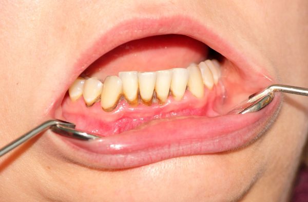 Dentalni centar DentIN, Zagreb, Trešnjevka: nakupljeni zubni kamenac koji narušava estetiku zubi.