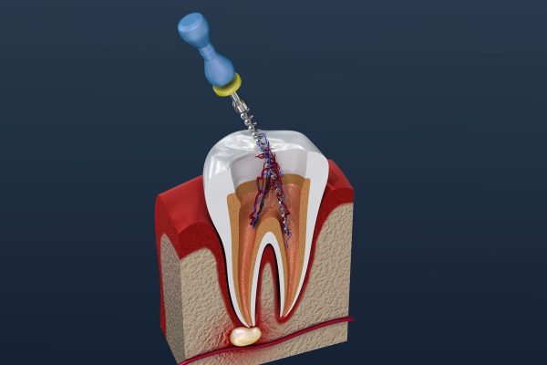 Dentalni centar DentIN, Zagreb, Trešnjevka: grafički prikaz čišćenje zubnog korijena posebnim svrdlom.